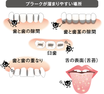 プラークが溜まりやすい場所